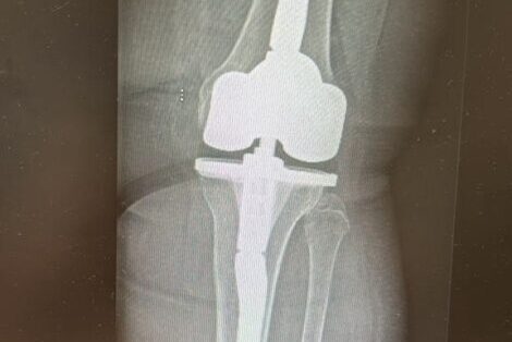 В чем преимущества эндопротезирования коленного сустава по ОМС и квоте?